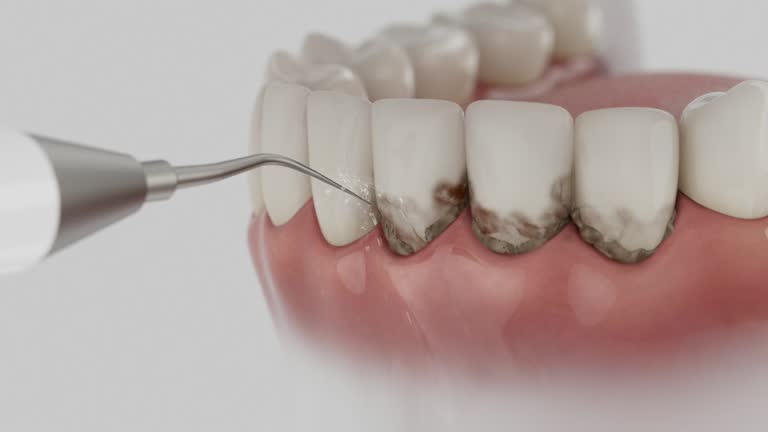 Trusted Wisdom Tooth Removal service in Hamilton, IN - Dentist Open Now